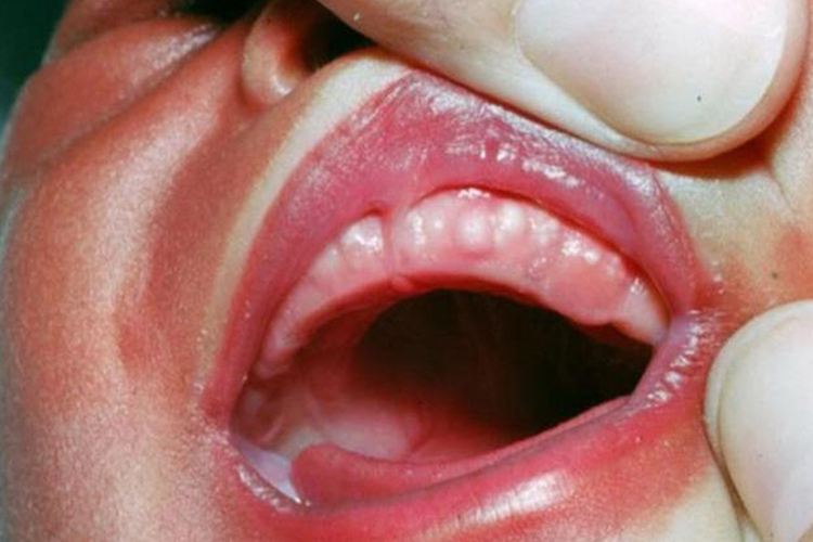 图病因婴儿长米牙,是乳牙发育时留下来的暴露在牙床外的牙胚残余组织