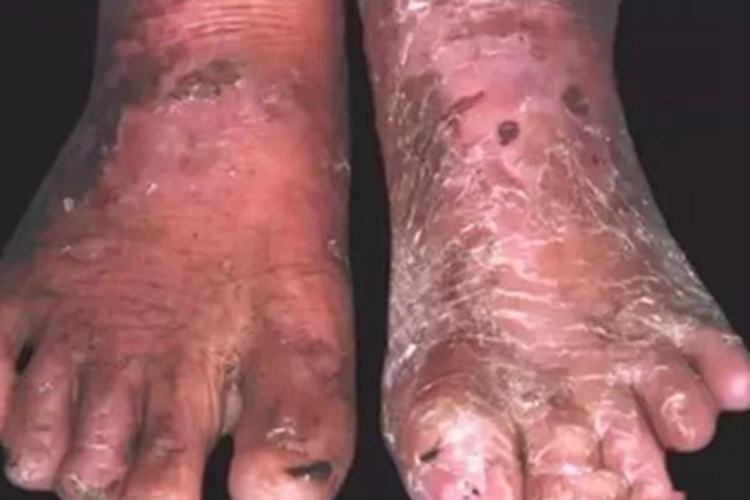 大疱性表皮松解症脚部脱屑图 大疱性表皮松解症脚部脱屑图