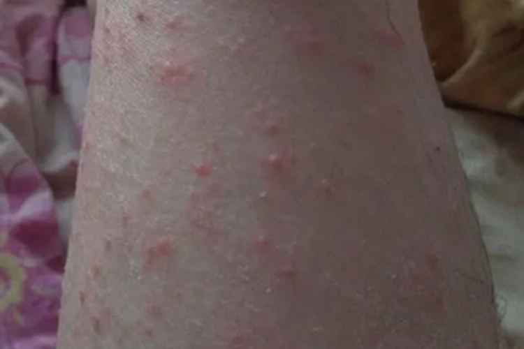 热带痤疮小腿上长小红疙瘩图
