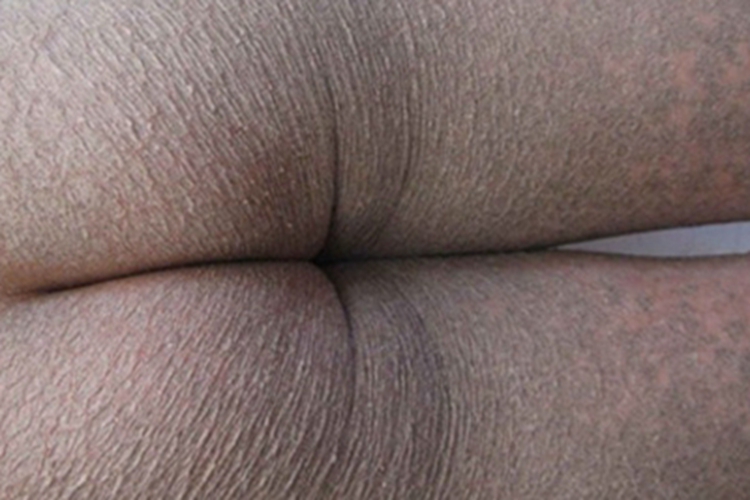 鱼鳞病臀部症状图 鱼鳞病臀部症状图