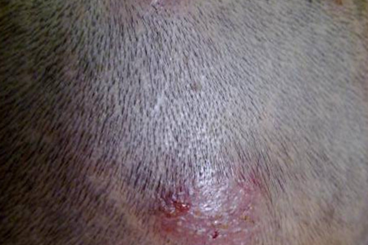 儿童脓癣初期图 儿童脓癣初期图