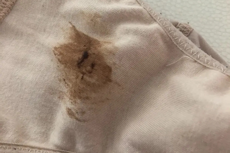 异位妊娠分泌物图 异位妊娠分泌物图