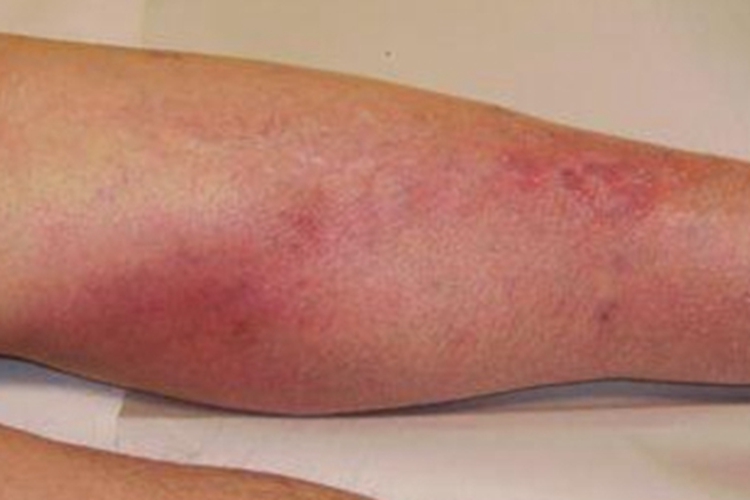 游走性血栓性浅静脉炎红肿图