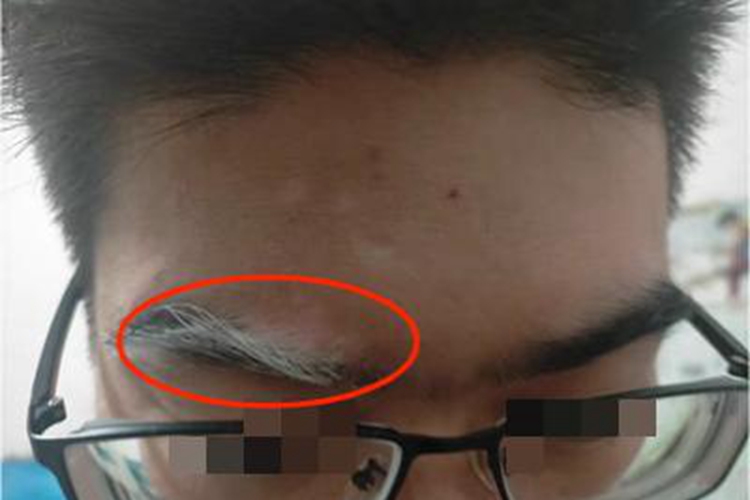 节段型白癜风眉毛毛发变白图