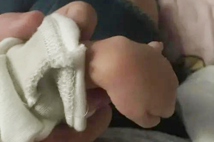 新生儿垂腕畸形手腕内弯图