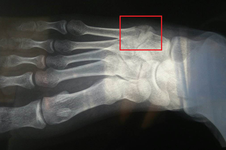 右脚骨裂X光片图