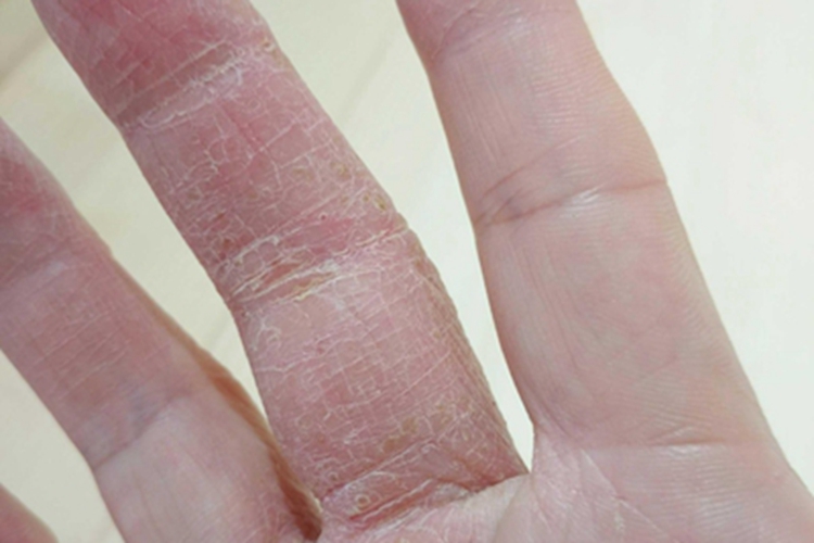 手部湿疹裂纹图