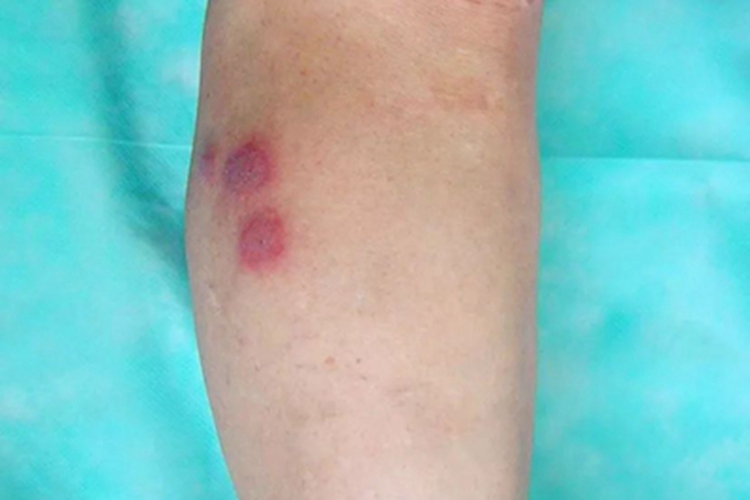 急性发热性嗜中性皮病腿部红斑图