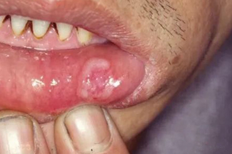 颌面部获得性梅毒唇内侧症状图
