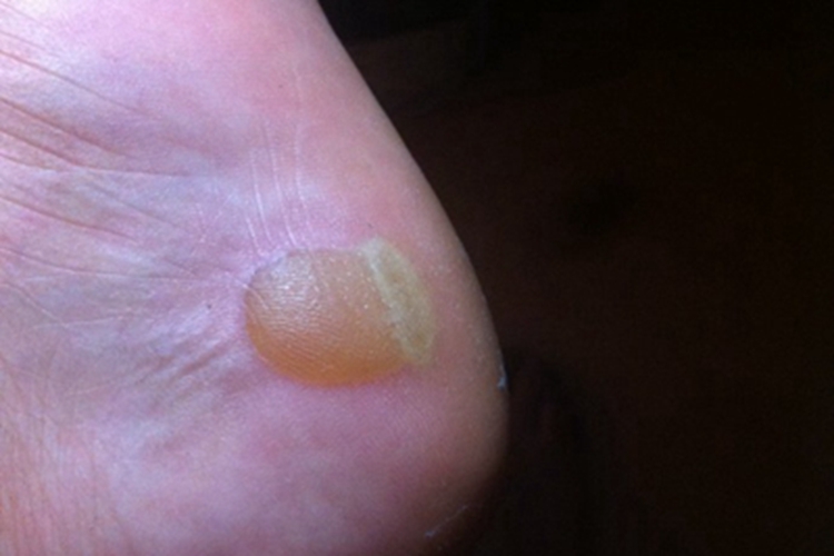 蜈蚣蜇伤症状图 蜈蚣蜇伤症状图