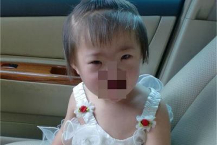 唐氏综合征面部症状图