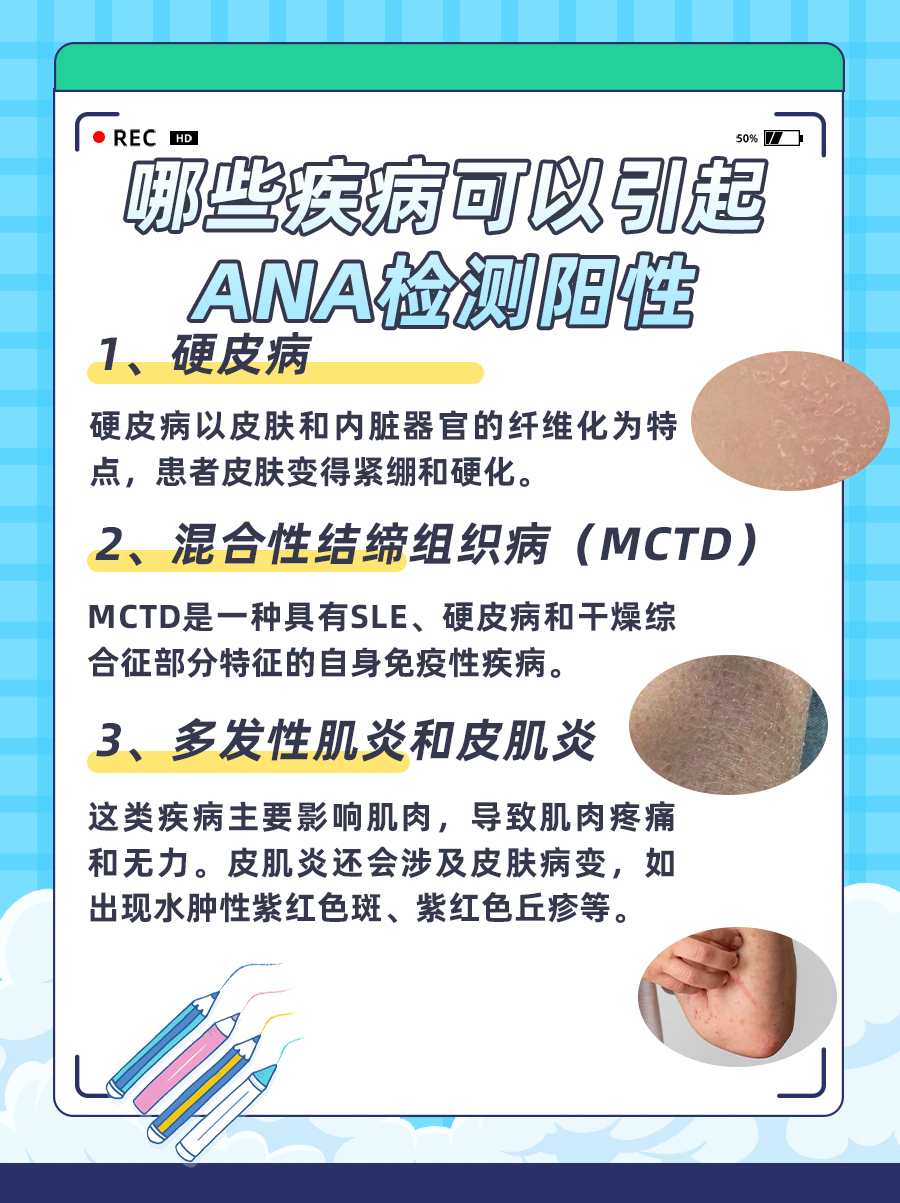 ANA检测阳性？可能是这些疾病的征兆！