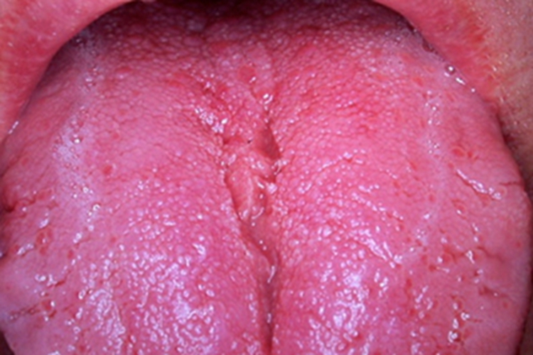 三期口腔梅毒舌头红肿图