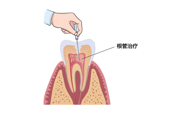 如何判断牙是否漏神经-有来医生