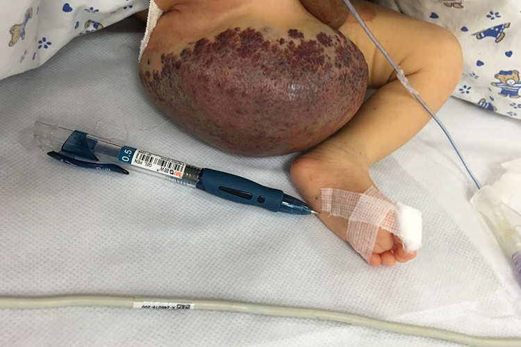 海绵状血管瘤图