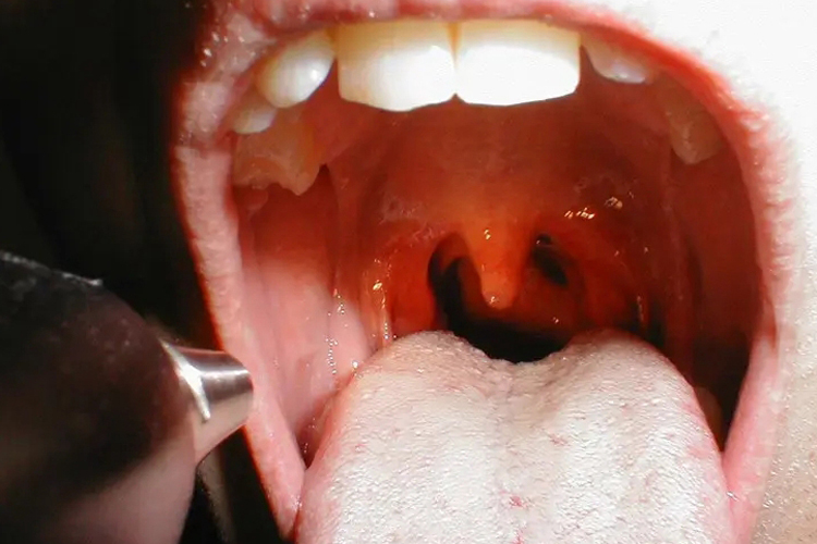 艾滋病初期咽喉炎充血图