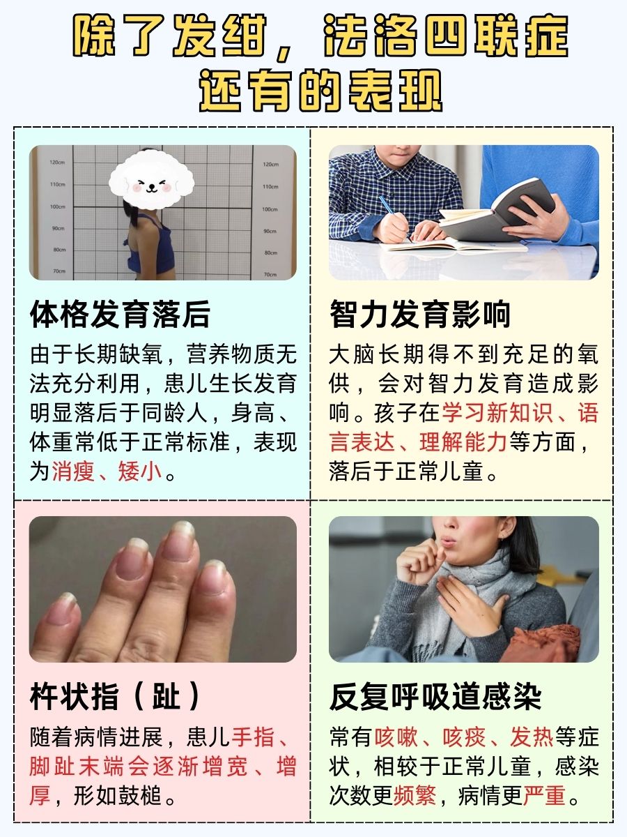 先天性法洛四联症发绀啥表现？速记！