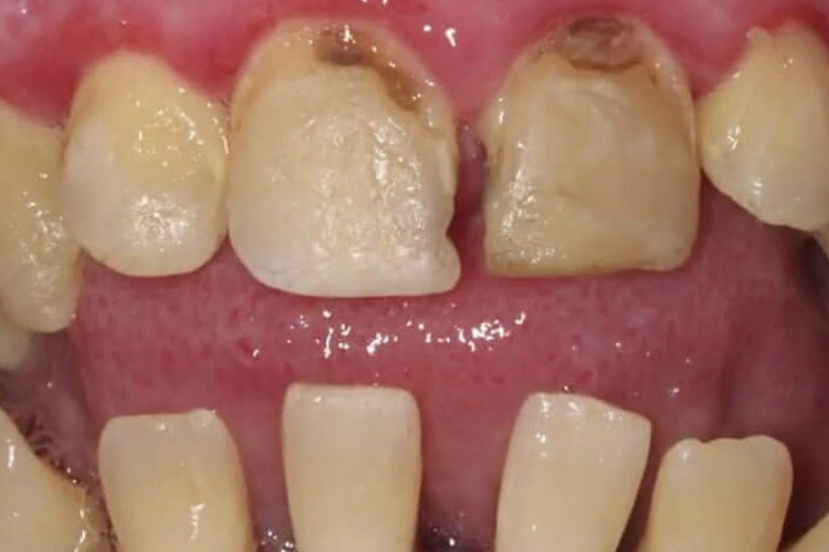 牙结石牙齿边缘发黑图 牙结石牙齿边缘发黑图