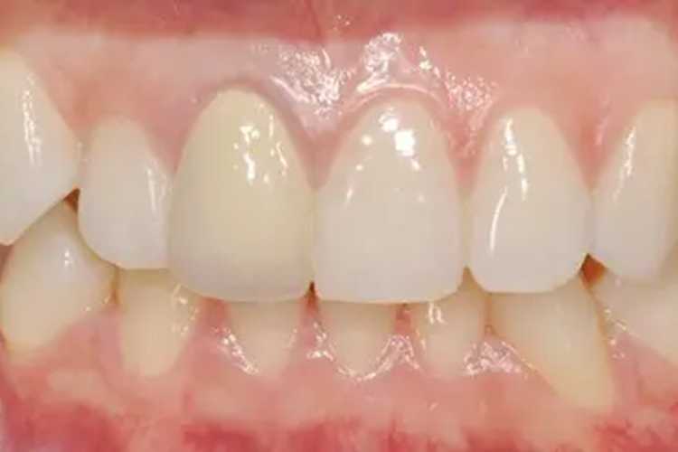 正常人的牙龈图