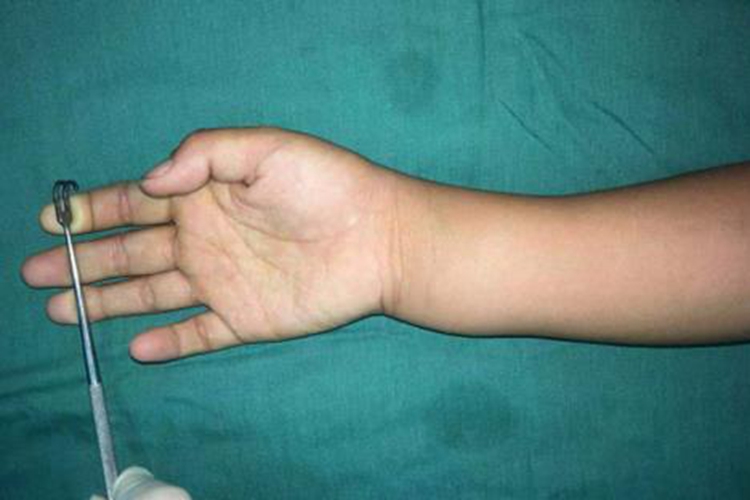 右尺骨茎突骨折肿胀图