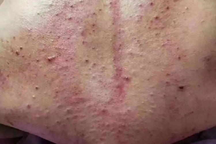 细菌性毛囊炎背部丘疹图