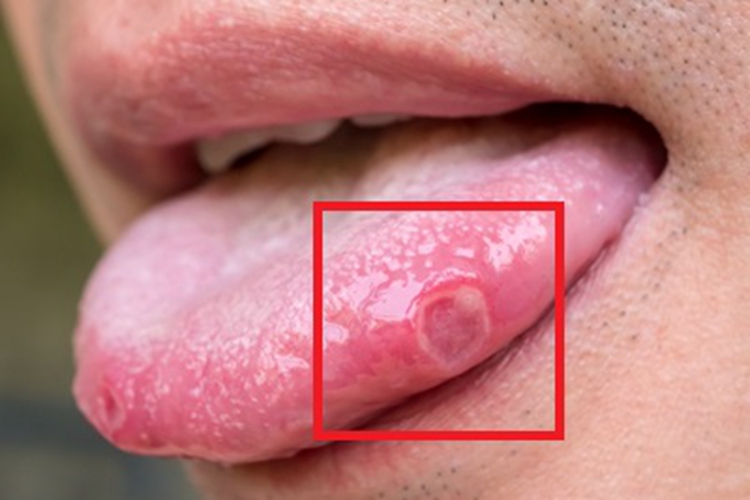 艾滋病舌侧溃疡图 艾滋病舌侧溃疡图