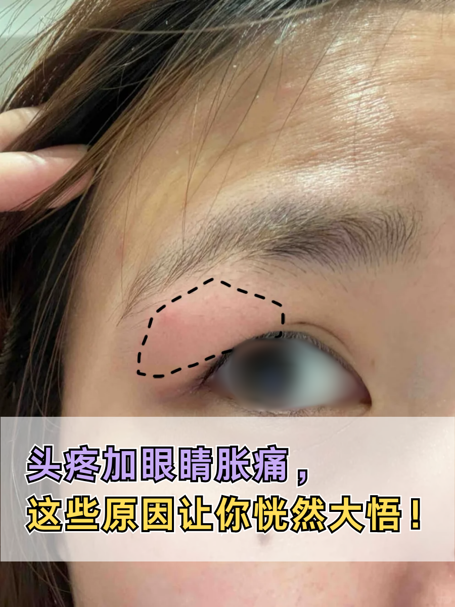 头疼加眼睛胀痛，这些原因让你恍然大悟！