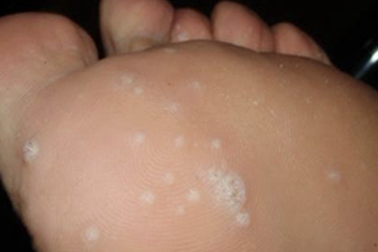 汗疱疹脚底症状图 汗疱疹脚底症状图