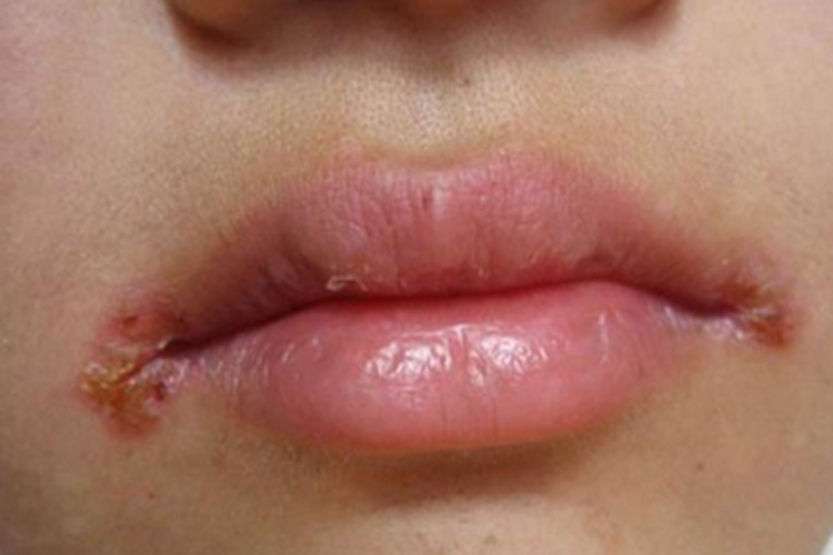 感染性口角炎嘴唇皲裂图 感染性口角炎嘴唇皲裂图