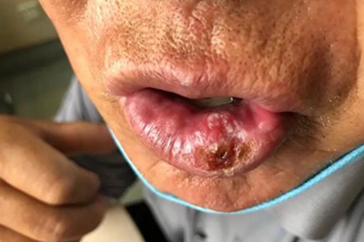 梅毒性唇下疳嘴唇结痂图