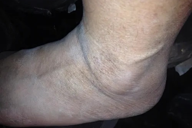 家族性进行性色素沉着脚踝症状图