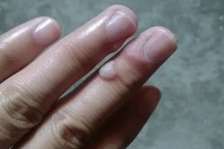 经典型上皮样肉瘤手指疙瘩图