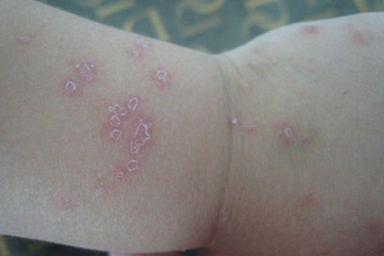 虫咬皮炎脱屑图