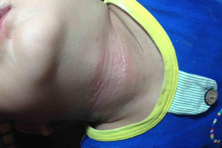 间擦疹初期症状图