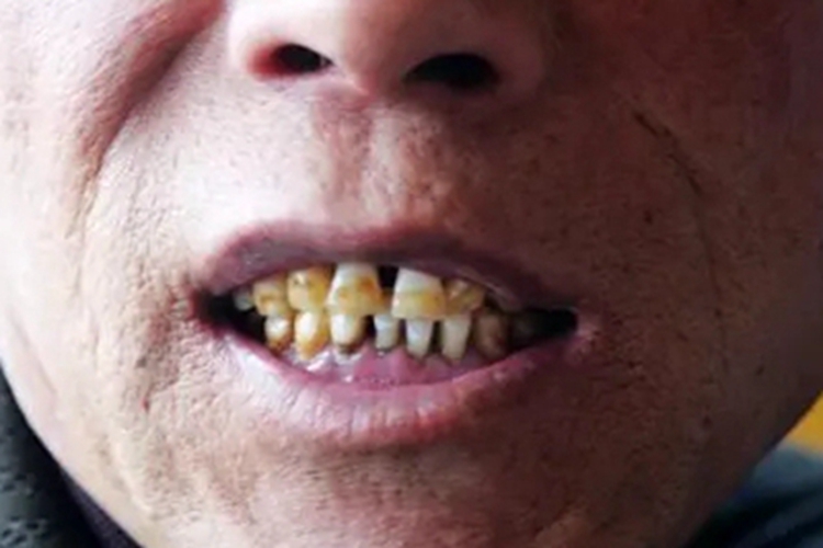 氟牙症牙齿大片褐斑图