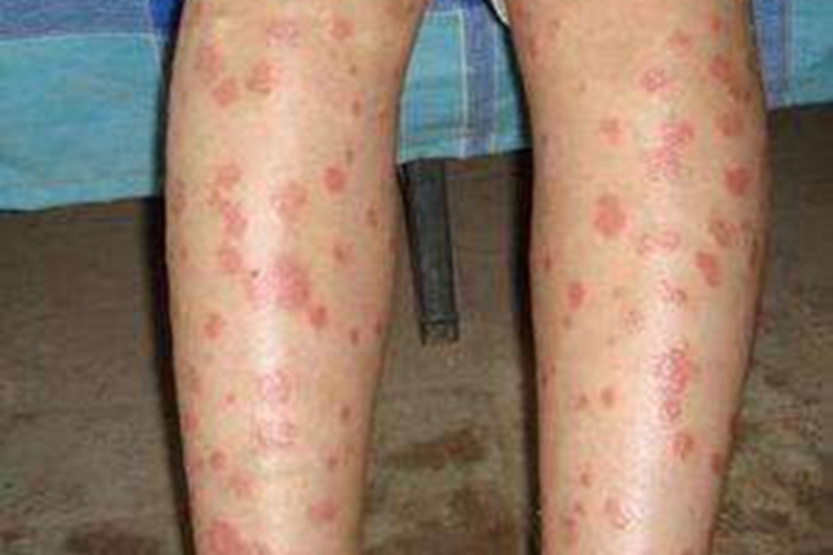 寻常狼疮小腿散在分布红斑图