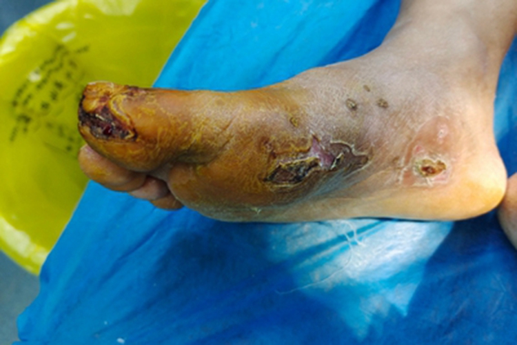 电烧伤脚底黑痂图 电烧伤脚底黑痂图