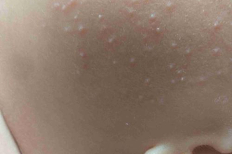 新生儿皮脂腺增生面部丘疹图