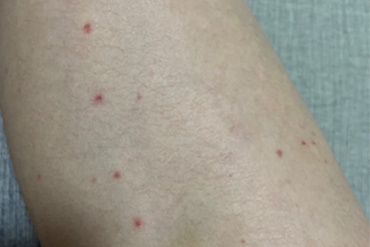 毛囊炎小腿丘疹图