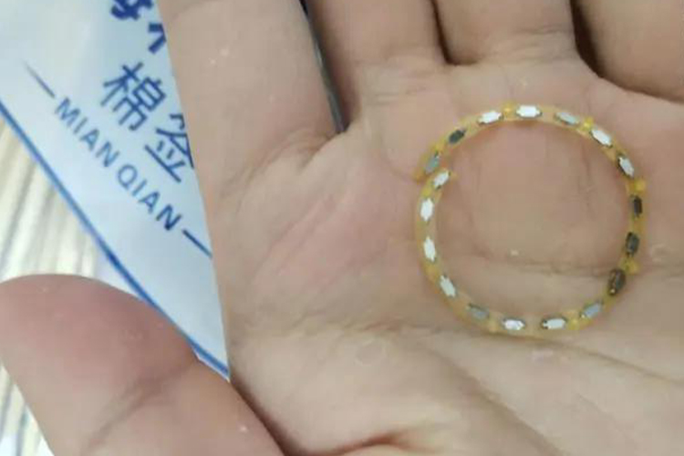 环切手术钛钉图