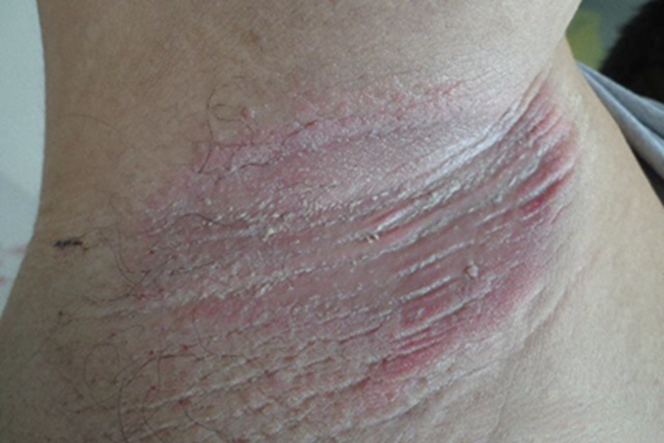 红癣腋窝有椭圆形红斑图 红癣腋窝有椭圆形红斑图