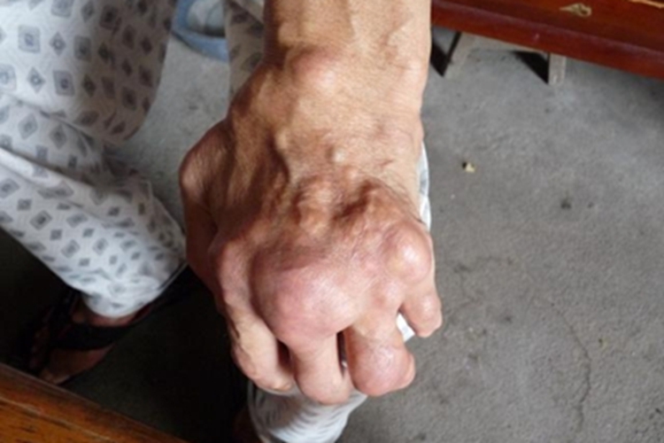 寻常狼疮手背结节图