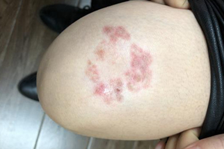 体癣腿部症状图