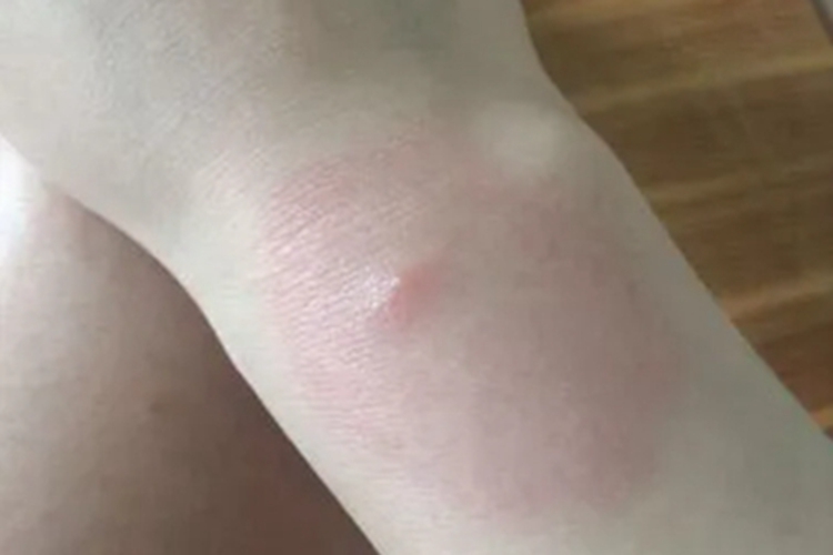 蠓虫叮咬引起的皮肤反应小疙瘩图