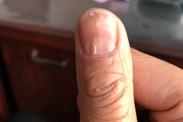 甲纵裂指甲裂开轻微突出图