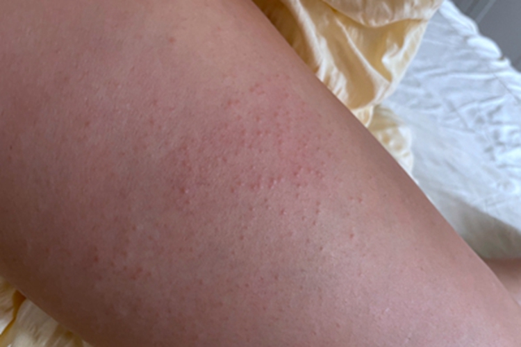 日光性皮炎胳膊小疙瘩图