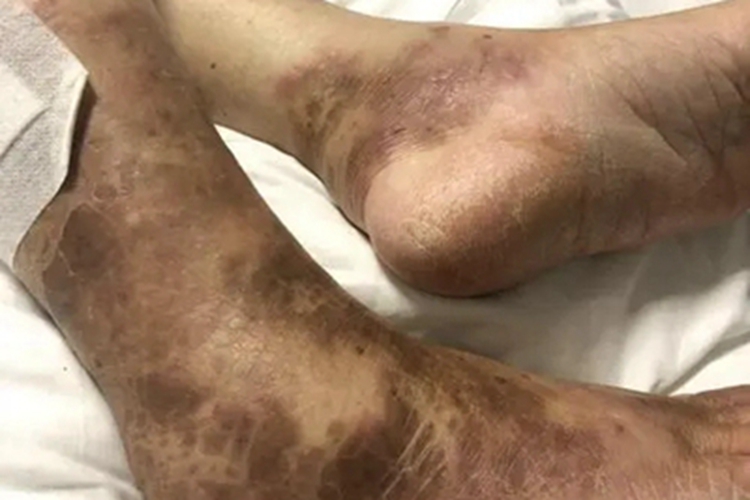 淤积性皮炎脚踝斑图