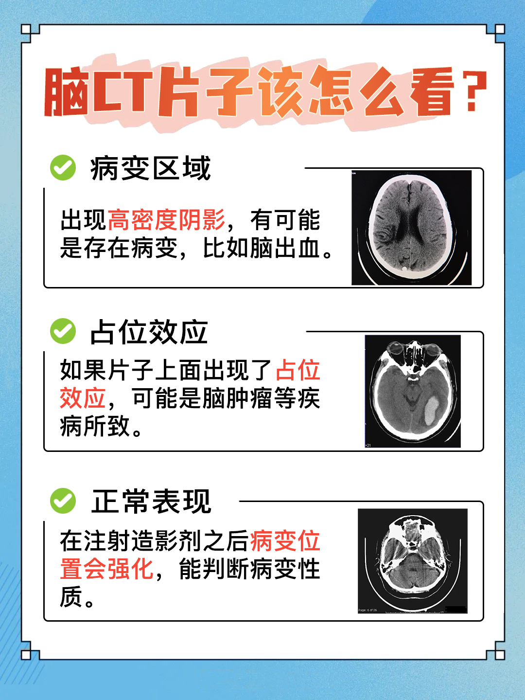 脑部CT的片子你知道怎么看吗？快来看详细教程