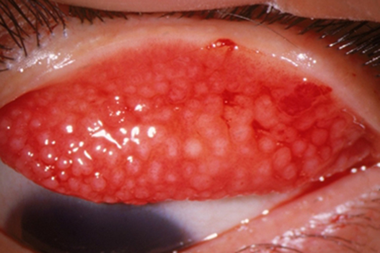 巨乳头性结膜炎充血图