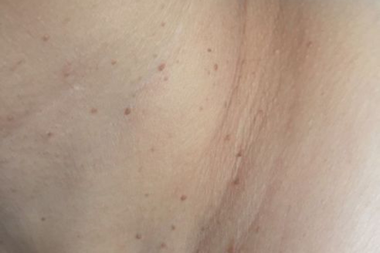 多发性皱纹状小丘疹图